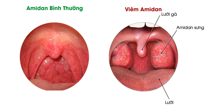 Viêm amidan là một trong những chứng bệnh thường gặp