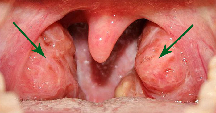 Viêm amidan quá phát độ 1,2,3,4 là gì? Nguyên nhân và cách điều trị